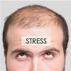 Hairloss caused by stress